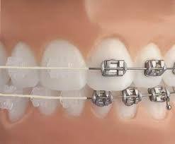 braces