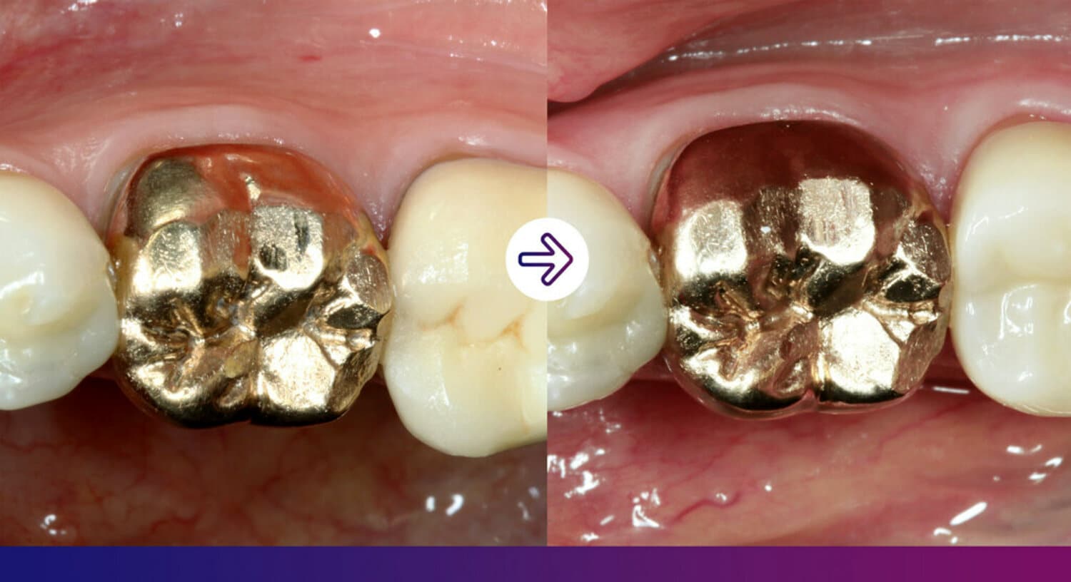 Before & After: All ceramic crown restoration clinical case.