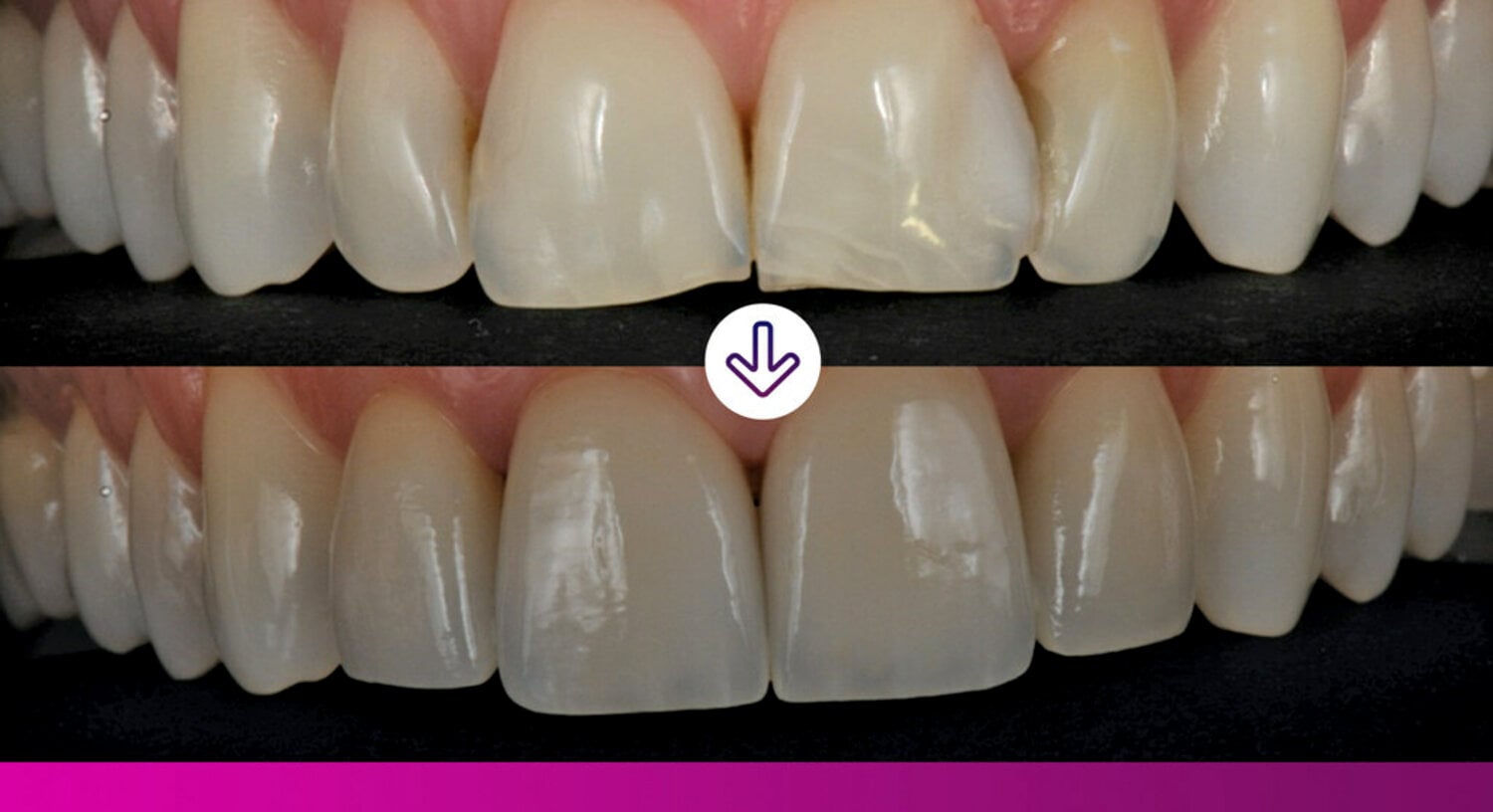 image of teeth before and after colour matching