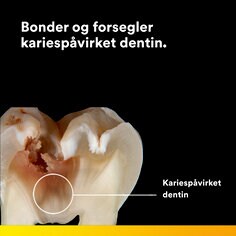 Bonder og forsegler kariespåvirket dentin